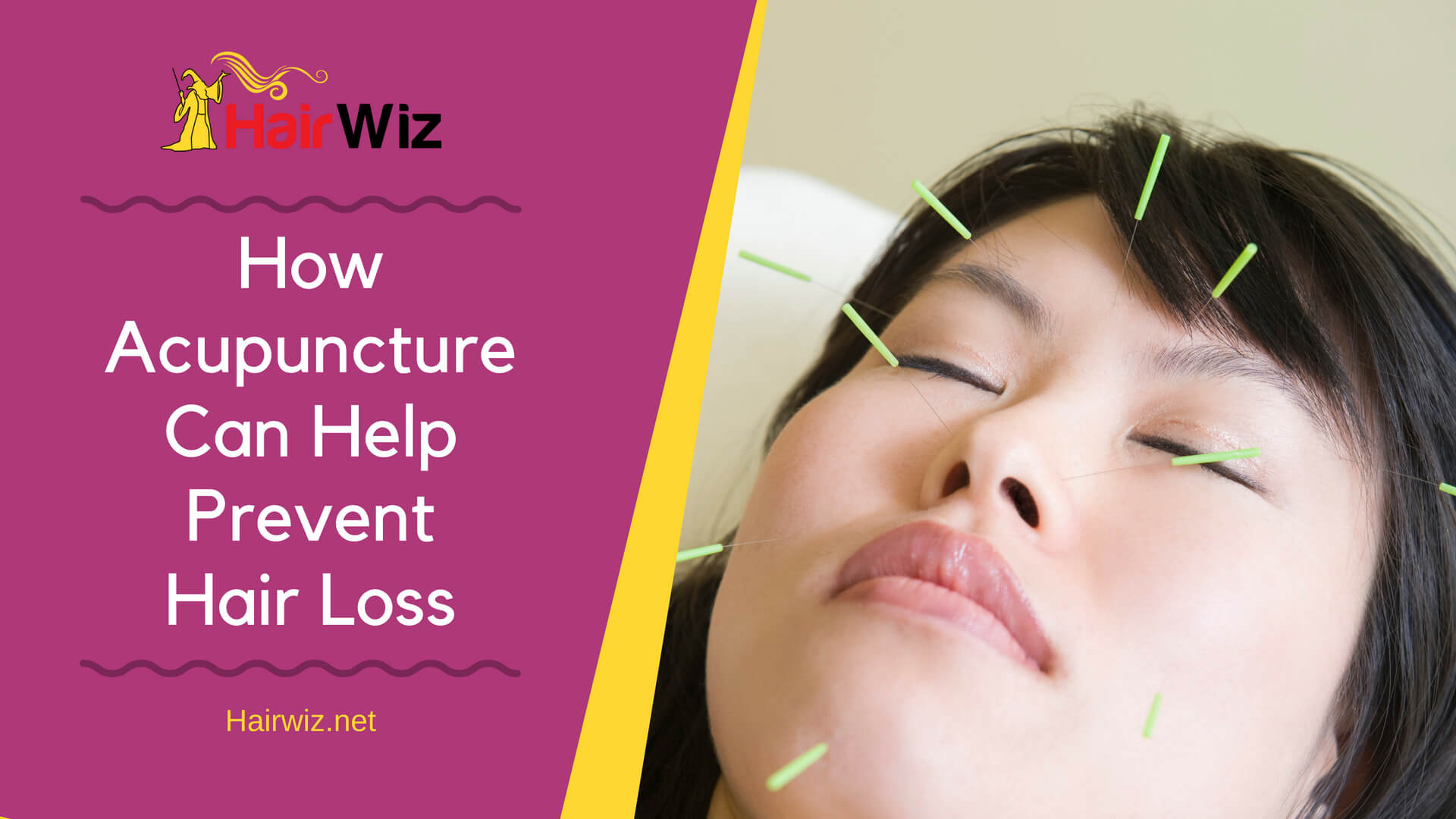 Benefits of Acupuncture For Hair Loss | Pressure Points For Hair Growth